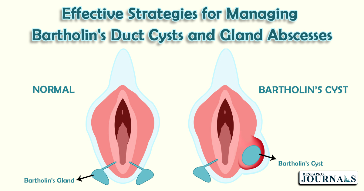 Office Management of Bartholin Gland Cysts and Abscesses